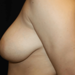 Breast Reduction Before & After Patient #28835