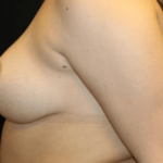 Breast Reduction Before & After Patient #28835