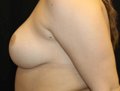Breast Reduction Before & After Patient #28835