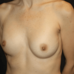 Breast Implant Exchange Before & After Patient #28815