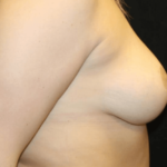 Breast Reduction Before & After Patient #28835