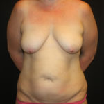 Tummy Tuck Before & After Patient #28731