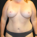 Tummy Tuck Before & After Patient #28731