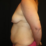 Tummy Tuck Before & After Patient #28731