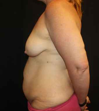 Tummy Tuck Before & After Patient #28731