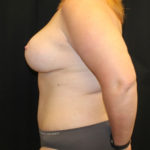 Tummy Tuck Before & After Patient #28731
