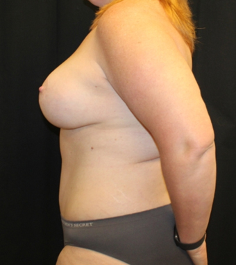 Tummy Tuck Before & After Patient #28731