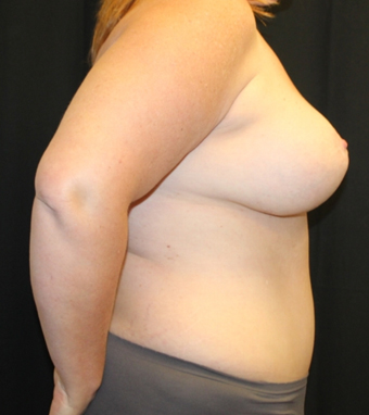 Tummy Tuck Before & After Patient #28731