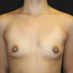 Breast Augmentation - Round Silicone Implants Before & After Patient #28660