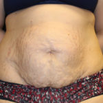 Tummy Tuck Before & After Patient #28742