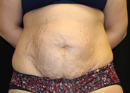 Tummy Tuck Before & After Patient #28742