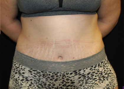 Tummy Tuck Before & After Patient #28742