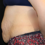 Tummy Tuck Before & After Patient #28742