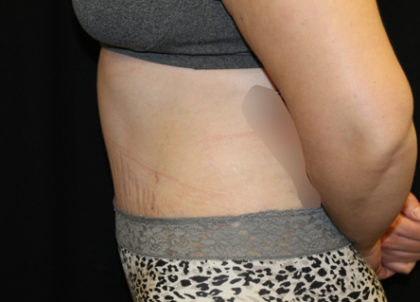 Tummy Tuck Before & After Patient #28742