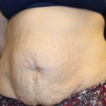 Tummy Tuck Before & After Patient #28742