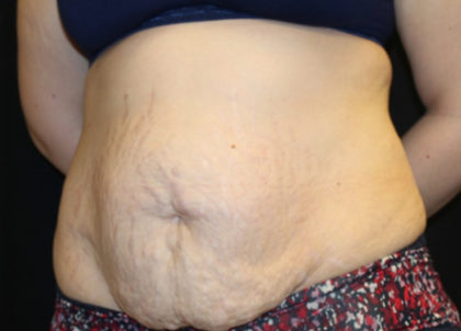 Tummy Tuck Before & After Patient #28742