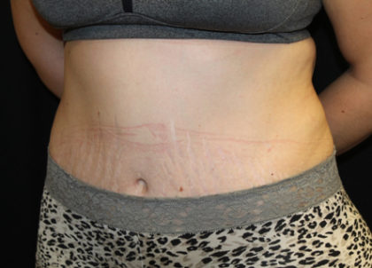 Tummy Tuck Before & After Patient #28742