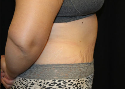 Tummy Tuck Before & After Patient #28742