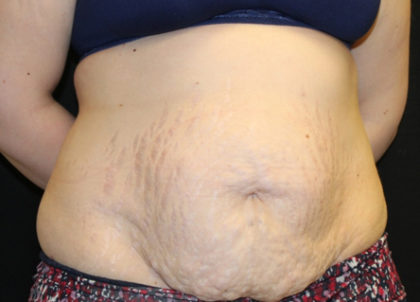 Tummy Tuck Before & After Patient #28742