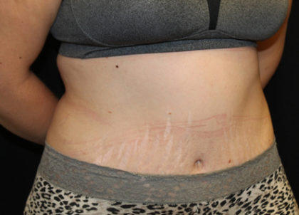 Tummy Tuck Before & After Patient #28742
