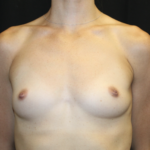 Breast Augmentation - Round Silicone Implants Before & After Patient #28523