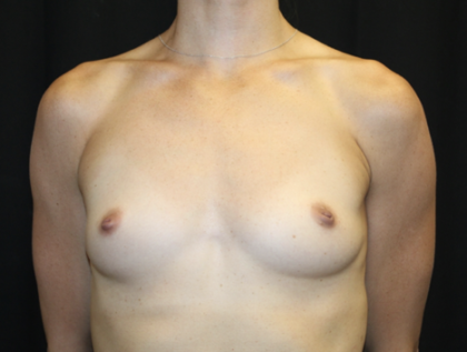 Breast Augmentation - Round Silicone Implants Before & After Patient #28523