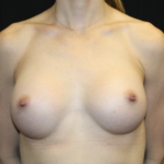 Breast Augmentation - Round Silicone Implants Before & After Patient #28523