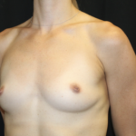 Breast Augmentation - Round Silicone Implants Before & After Patient #28523