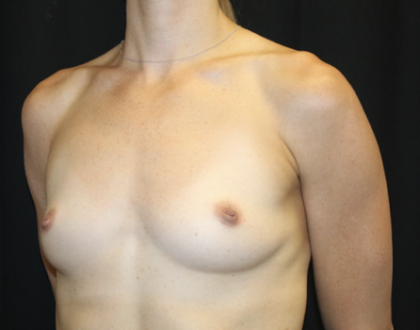 Breast Augmentation - Round Silicone Implants Before & After Patient #28523