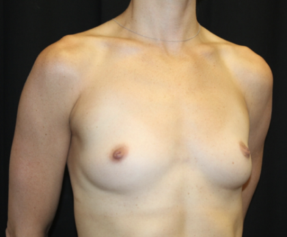Breast Augmentation - Round Silicone Implants Before & After Patient #28523