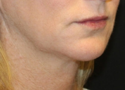 Injectable Fillers Before & After Patient #28753