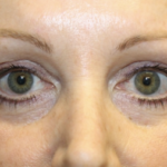 Blepharoplasty Before & After Patient #28633