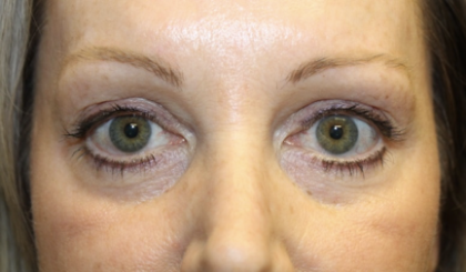 Blepharoplasty Before & After Patient #28633