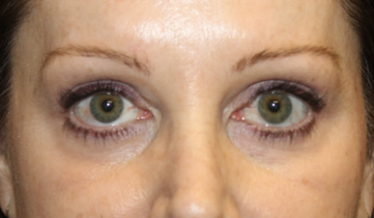 Blepharoplasty Before & After Patient #28633