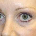 Blepharoplasty Before & After Patient #28633