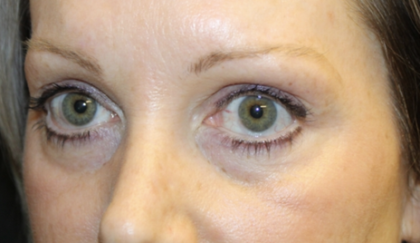 Blepharoplasty Before & After Patient #28633