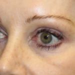 Blepharoplasty Before & After Patient #28633