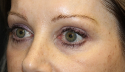 Blepharoplasty Before & After Patient #28633