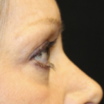 Blepharoplasty Before & After Patient #28633