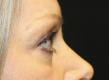 Blepharoplasty Before & After Patient #28633