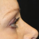 Blepharoplasty Before & After Patient #28633