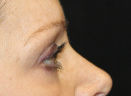 Blepharoplasty Before & After Patient #28633