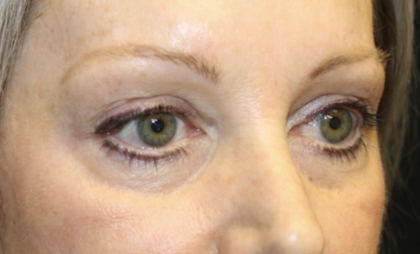 Blepharoplasty Before & After Patient #28633