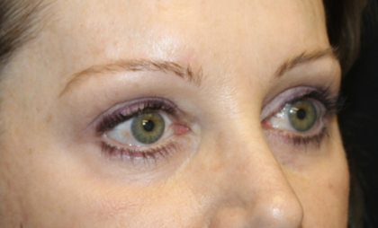Blepharoplasty Before & After Patient #28633