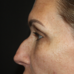 Rhinoplasty Before & After Patient #28642