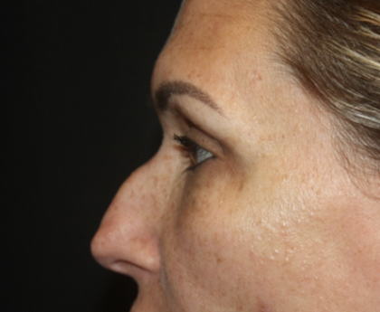 Rhinoplasty Before & After Patient #28642