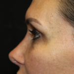 Rhinoplasty Before & After Patient #28642
