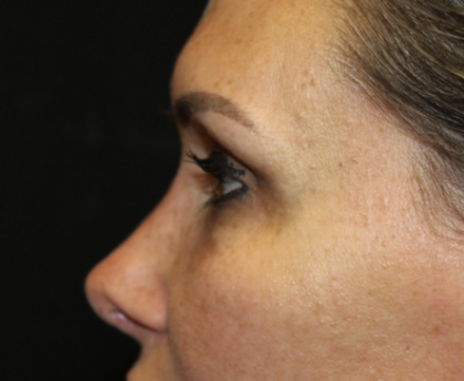 Rhinoplasty Before & After Patient #28642