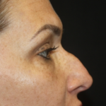 Rhinoplasty Before & After Patient #28642