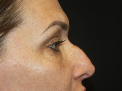 Rhinoplasty Before & After Patient #28642